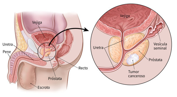 Cómo cuidar la próstata: consejos y recomendaciones