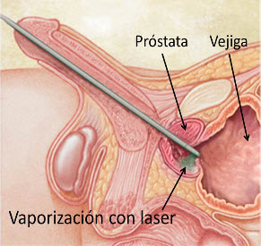 Gráfica que muestra cómo es el procedimiento de la enucleación endoscópica de próstata